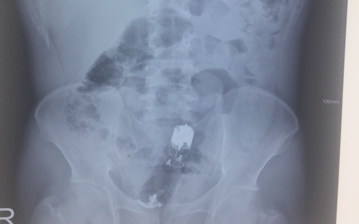 Dị vật trong trực tràng - Hình ảnh minh họa